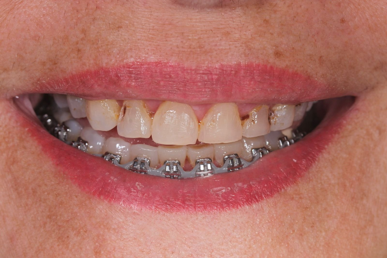 Depois — restauração