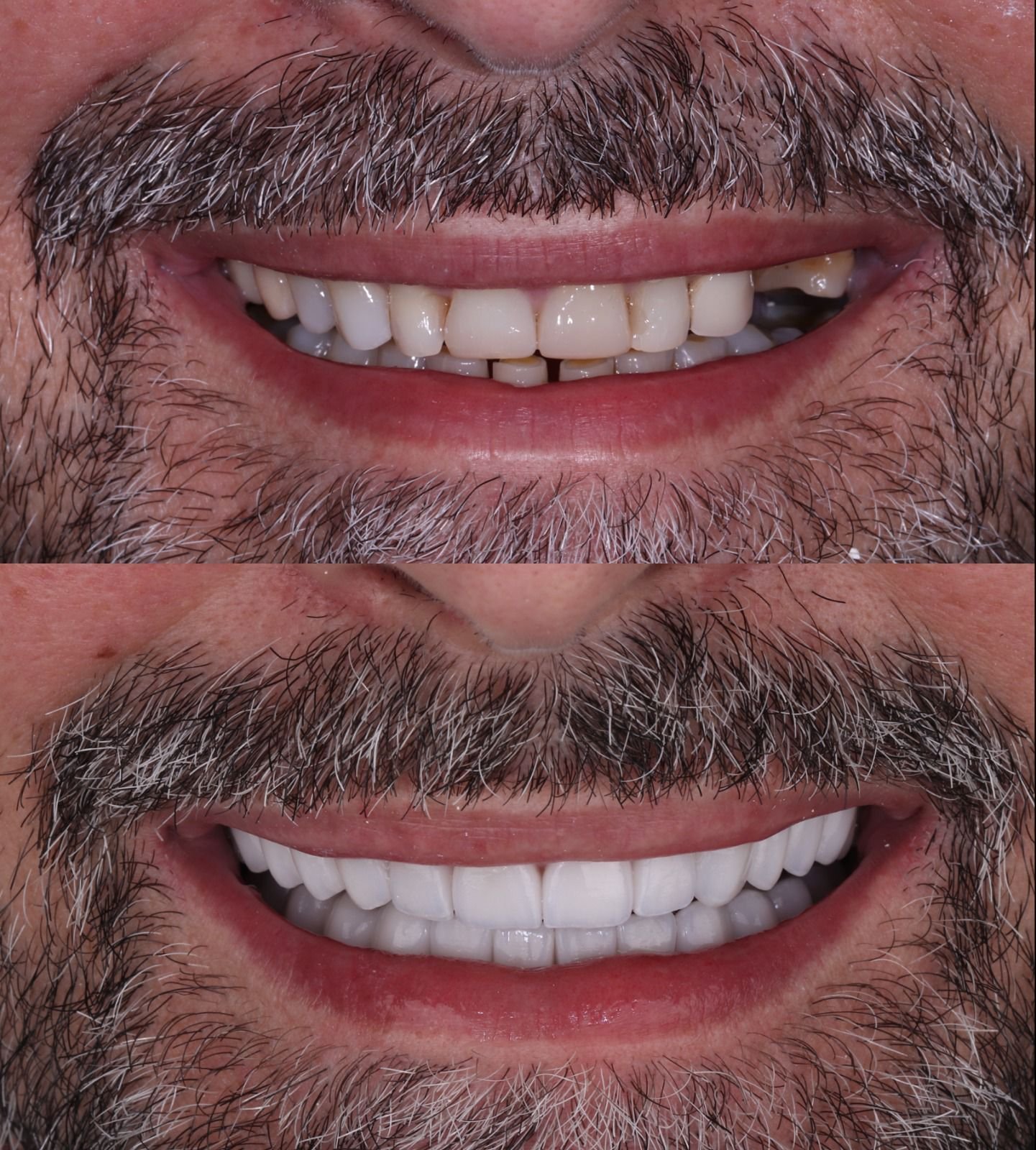 Resultado real — facetas em porcelana