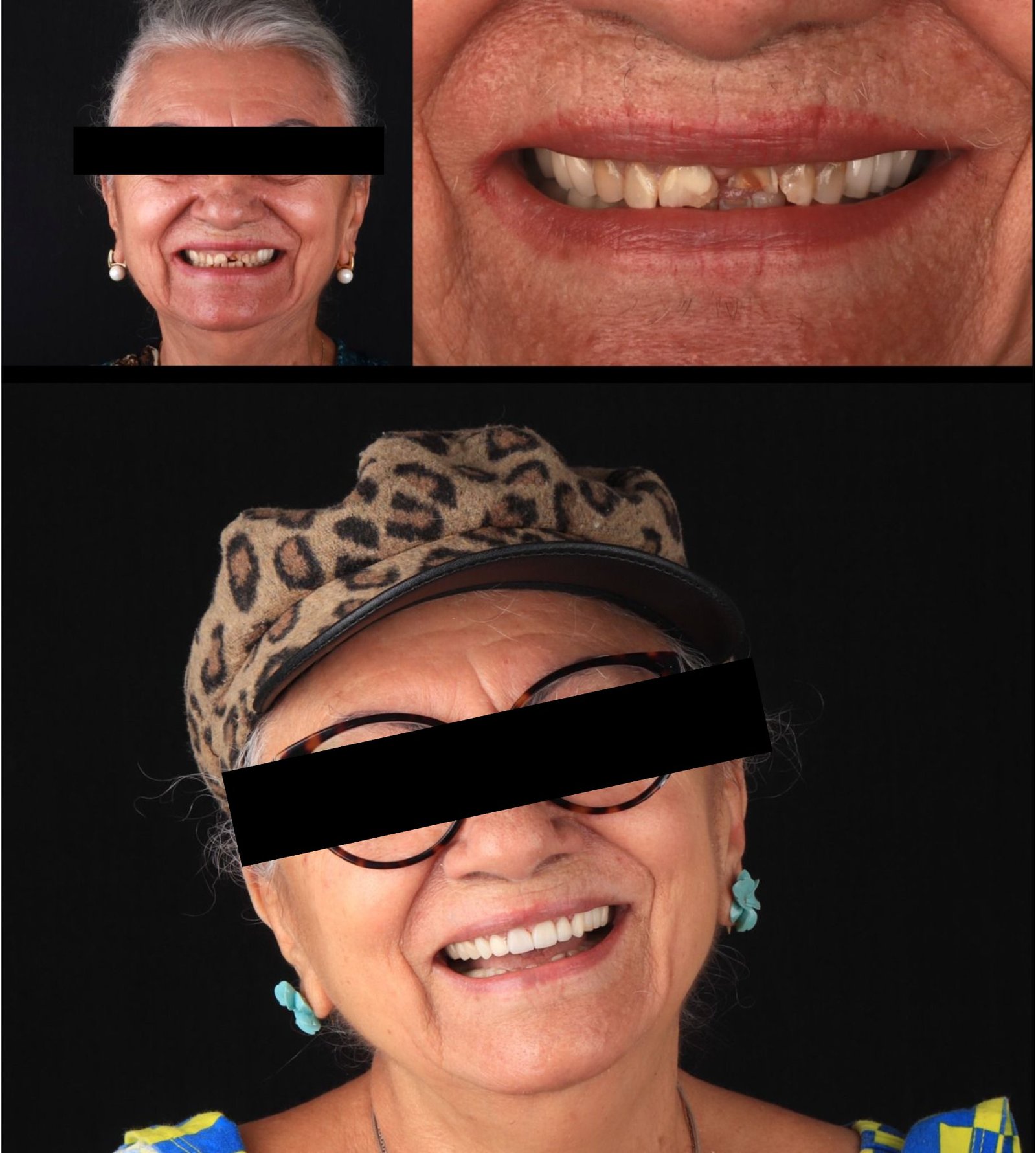 Antes e depois — reabilitação com implantes