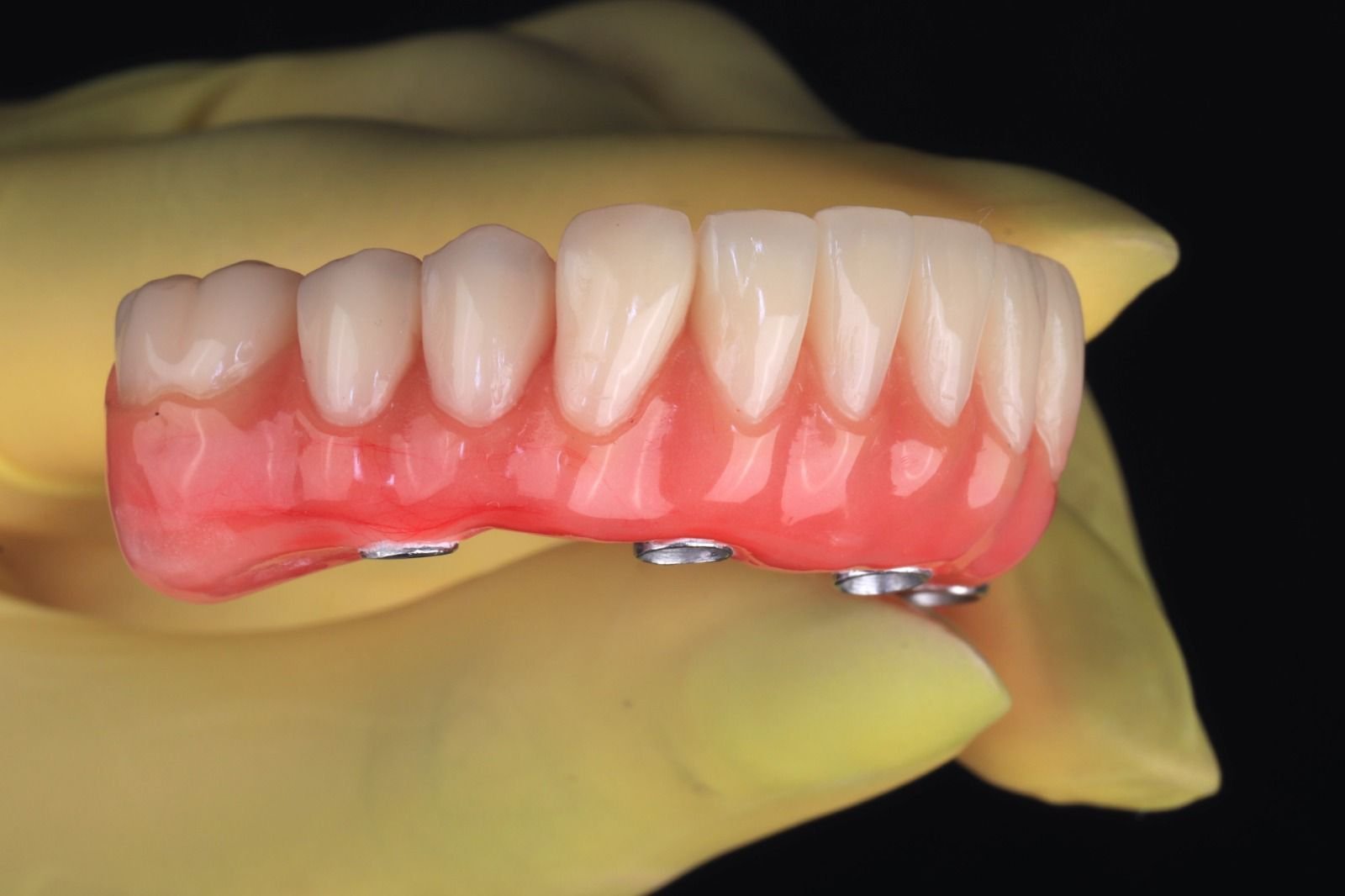 Prótese All-on — arcada superior